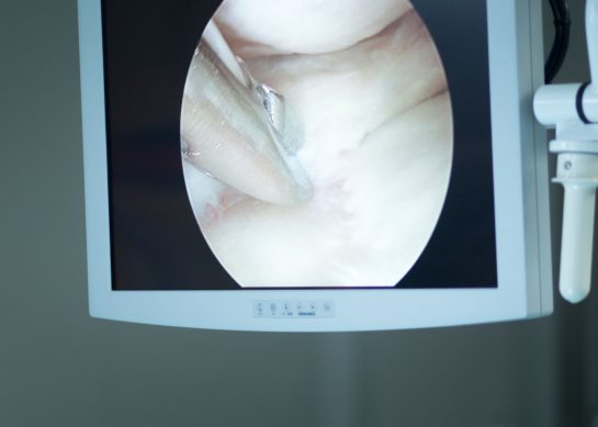Artroscopia di spalla: chirurgia e riabilitazione