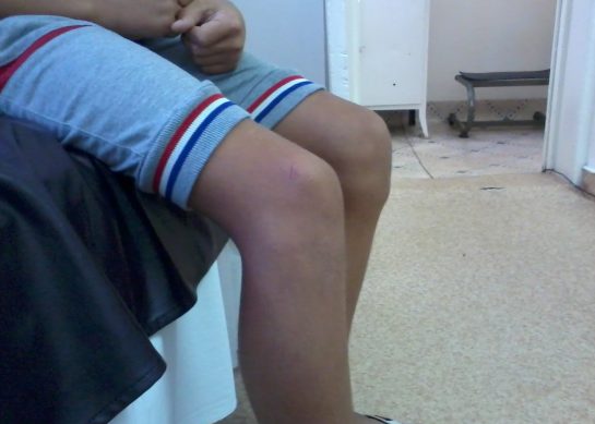 Osgood schlatter: sintomi e trattamento